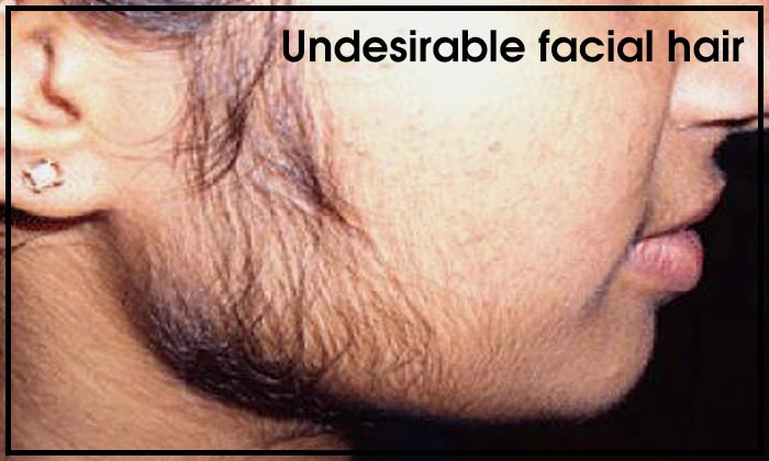 Undesirable facial hair