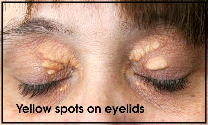 Yellow spots on eyelids