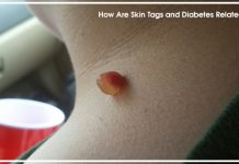 Is There an Association Between Skin Tags and Diabetes?