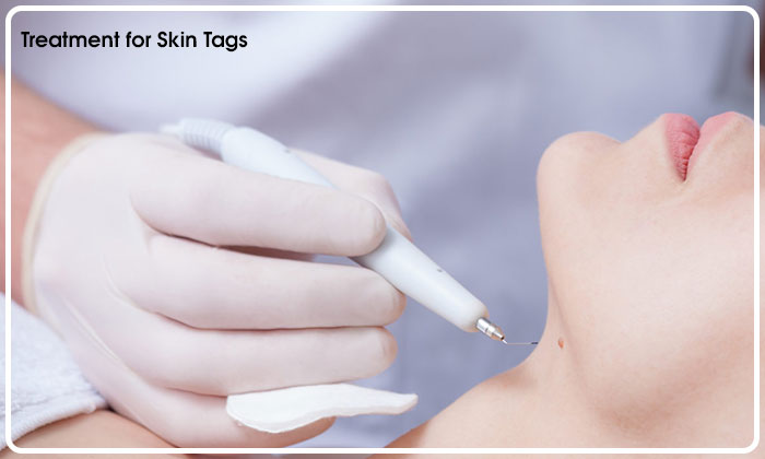 Treatment for Skin Tags