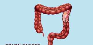 Colon-cancer-cover