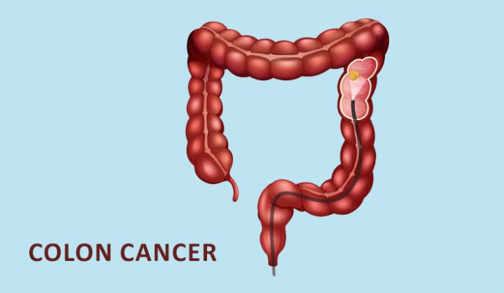 Top 10 Symptoms of Colon Cancer